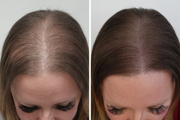 Micro Artistry Hair Clinic